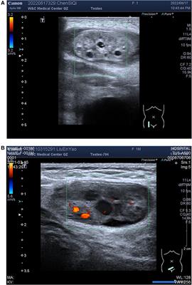 The clinical value of ultrasound in assessing ovarian strangulation in female infants and toddlers with ovarian hernia